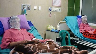 آمار سوختگی در ایران ۸ برابر متوسط جهانی