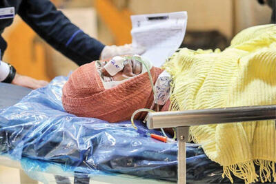 میزان سوختگی در ایران 8 برابر میانگین جهانی