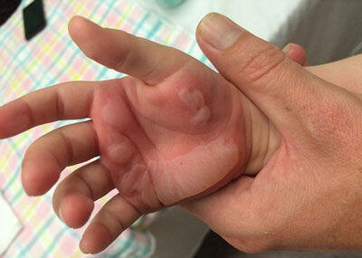 چرا سوختگی در کودکان به مراتب خطرناک‌تر از بزرگسالان است؟