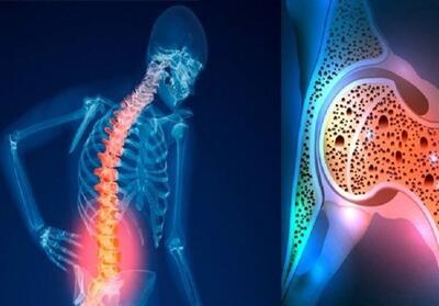 نقش الگوهای غذایی در پیشگیری و کنترل پوکی استخوان - تسنیم