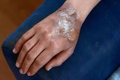  بهترین اقدام در سوختگی چیست؟