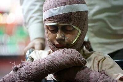 قیمت لباس سوختگی ۲ تا ۴۰ میلیون تومان