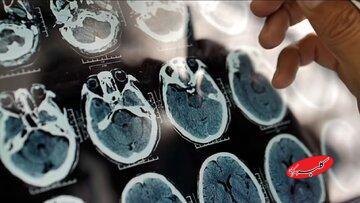  یک عامل مهم و کمتر گفته شده درباره روند پیشرفت آلزایمر - کلبه سرگرمی