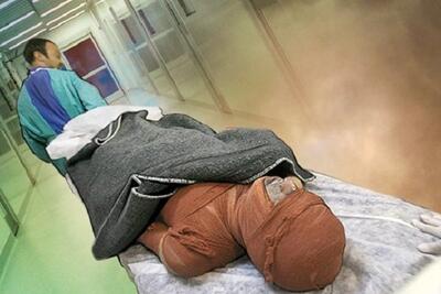 کمبود هزار تخت بیمارستانی سوختگی در کشور