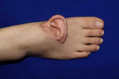 یک گام عجیب در پزشکی؛ گوش به پا پیوند زده شد