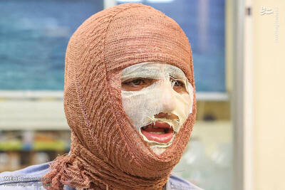 پوشش بیمه‌ای پانسمان‌های نوین سوختگی و مشکلات هزینه‌های درمان