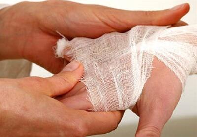 هزینه بستری بیماران سوختگی چقدر است؟ - تسنیم