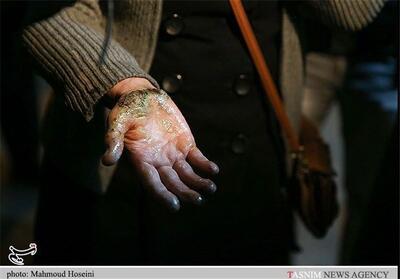 وقوع سالانه 300هزار مورد سوختگی/ تخت سوختگی استاندارد در بخش دولتی نداریم - تسنیم