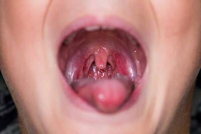 تعریفی از وجود لوزه در دهان