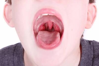 علائم کودکانی که لوزه سوم دارند