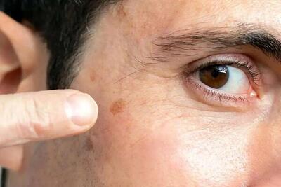 پیری پوست با خوردن بیش از حد غذاهای شور