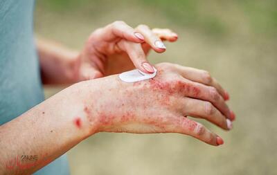 راه‌های آسان برای کنترل اگزما