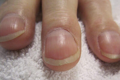 7 علامت ناخن که ممکن است خبر از کلسترول بالا بدهند