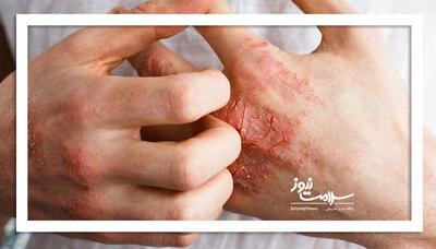 اگزما با این راهکارها درمان می‌شود