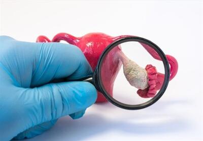 امید تازه برای زنان مبتلا به تخمدان پلی‌کیستیک/تغذیه‌ای که افسردگی را کاهش می‌دهد - تسنیم