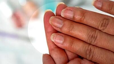  این ۷ نشانه در ناخن یعنی کلسترول شما بالا رفته است