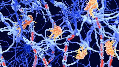 محققان 2 زیرنوع جدید از ام‌ اس را کشف کردند؛ پیشرفتی هیجان‌ انگیز