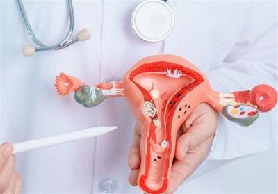 یک زن از هر 10 نفر دچار آندومتریوز می‌شود - تسنیم