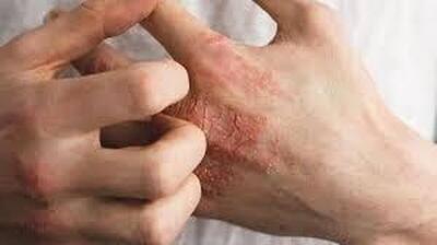  بلایی که خشکی بدن زمستان بر سر بدن می‌آورد