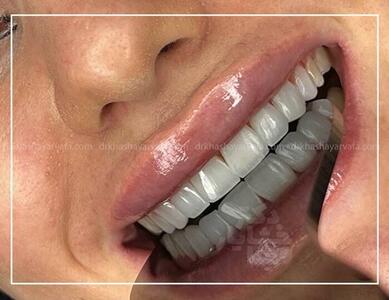 چطور کامپوزیت دندان در کمتر از یک جلسه لبخندتان را تغییر ‌می‌دهد؟