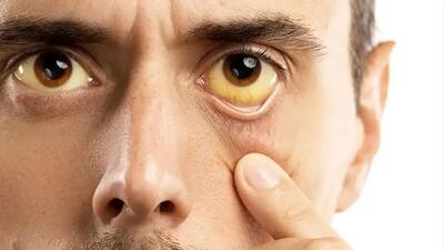  ۵ علامت هشداردهنده کبد چرب روی صورت