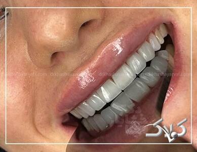 چطور کامپوزیت دندان در کمتر از یک جلسه لبخندتان را تغییر ‌می‌دهد؟ - مجله اینترنتی کولاک
