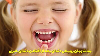  مدت زمان رویش دندان دائمی بعد از افتادن دندان شیری + علت دیر درآمدن دندان