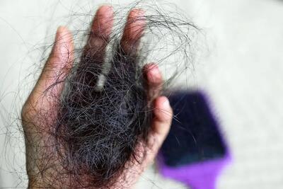 چرا موها در بارداری پرپشت می‌شوند و بعد از زایمان می‌ریزند؟