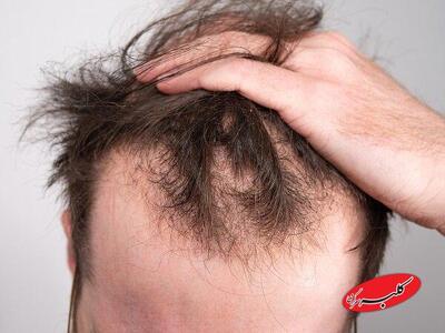  خوراکی‌هایی که به رشد مو کمک می‌کنند - کلبه سرگرمی