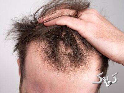 خوراکی‌هایی که به رشد مو کمک می‌کنند - مجله اینترنتی کولاک