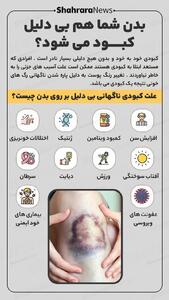  اینفوگرافی| بدن شما هم بی دلیل کبود می‌شود؟