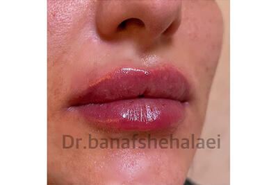  تزریق ژل برای چه کسانی ممنوع است؟