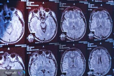  بومی‌سازی سلول‌درمانی برای درمان اختلال پارکینسون/ حمایت ۵ میلیارد تومانی از پژوهش‌های فناورانه حوزه علوم شناختی