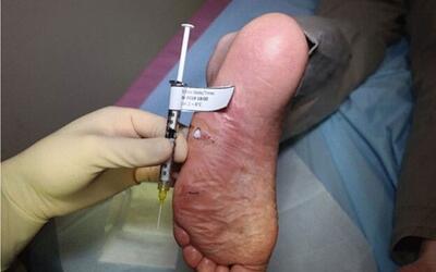  اثر درمانی سلول های بنیادی بر زخم دیابت | بررسی جدیدترین تحقیقات