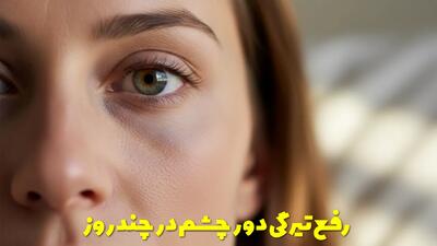 رفع تیرگی دور چشم در چند روز با چندین روش کاملا موثر + نکات