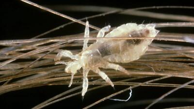  درمان خانگی شپش موی سر