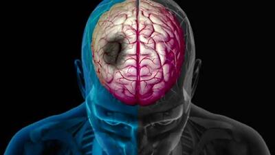 رابطه بین زمستان و سکته مغزی: نکاتی که باید بدانید