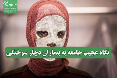 نگاه عجیب جامعه به بیماران دچار سوختگی