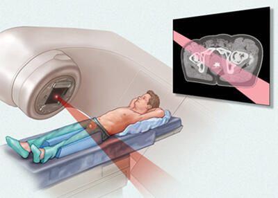 سرطان پروستات: تشخیص زودهنگام، کلید درمان کامل و زندگی طولانی‌تر - سلام نو