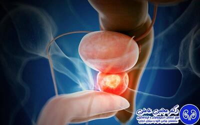  آیا سرطان پروستات کشنده است؟