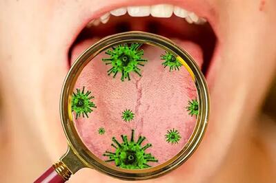یک باکتری دهانی می‌تواند ام‌اس را شدیدتر کند!