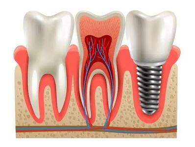  آیا برای ایمپلنت ریشه دندان لازم است؟ بررسی امکان ایمپلنت روی ریشه دندان