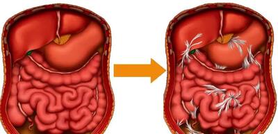 چسبندگی روده: علائم، علل و روش‌های تشخیص آن را بشناسید!