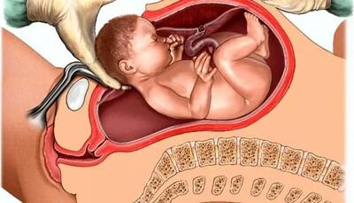 زخم‌های به‌جا‌مانده از سزارین؛ مشکلی که بارداری بعدی را تحت‌تأثیر قرار می‌دهد