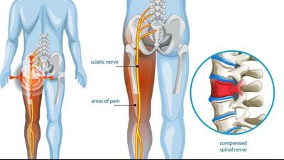 0 تا 100 درمان سیاتیک بدون دارو - مجله اینترنتی کولاک