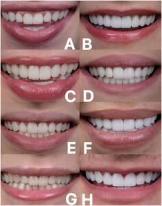 رنگ بندی و کاتالوگ کامپوزیت توکویاما