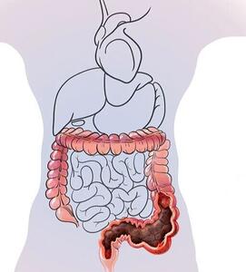 یبوست مزمن؛ اختلالی شایع که گاهی ریشه در کف لگن دارد