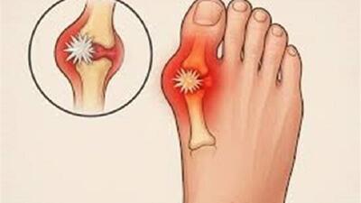 نقرس چیست و درمان اصولی آن چگونه است؟