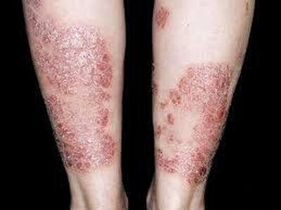 بیماری پسوریازیس (psoriasis) چیست؟