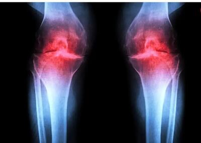  داروی جدیدی که می تواند آرتروز را درمان کند